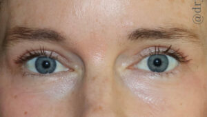 Eyelid Surgery Before and After Gallery