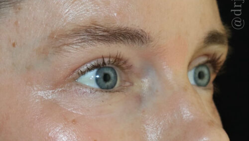 Eyelid Surgery Before and After Gallery