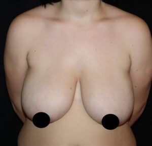 Breast Lift Before and After Gallery