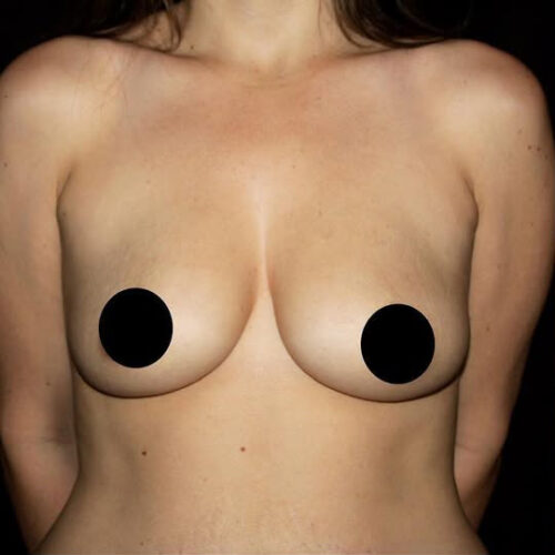 Breast Augmentation Before and After Gallery