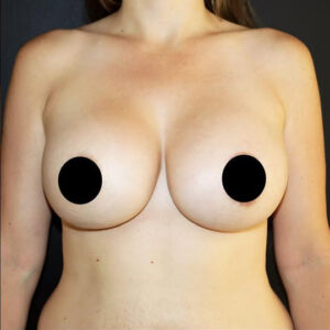 Breast Augmentation Before and After Gallery