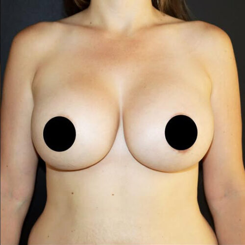 Breast Augmentation Before and After Gallery