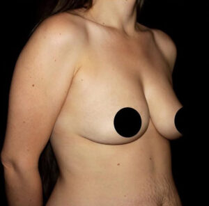 Breast Augmentation Before and After Gallery