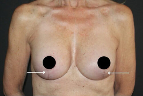 Scar Treatment Before and After Gallery