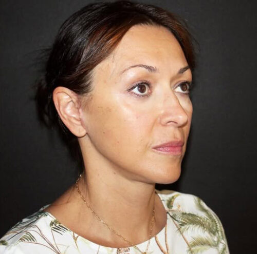 Face and Necklift Before and After Gallery