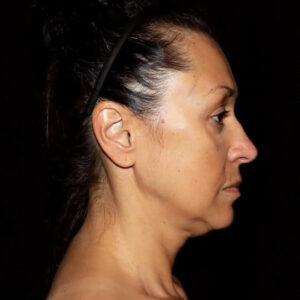 Face and Necklift Before and After Gallery
