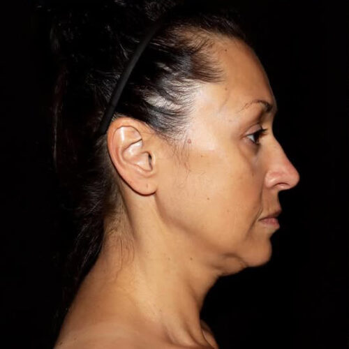 Face and Necklift Before and After Gallery