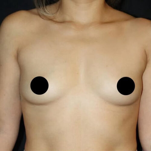 Breast Augmentation Before and After Gallery