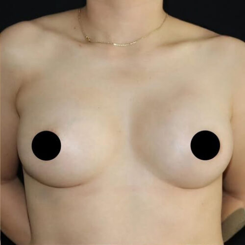 Breast Augmentation Before and After Gallery