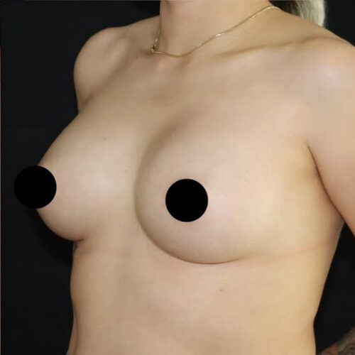 Breast Augmentation Before and After Gallery