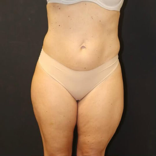 Liposuction Before and After Gallery