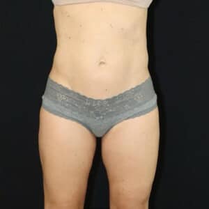 Liposuction Before and After Gallery