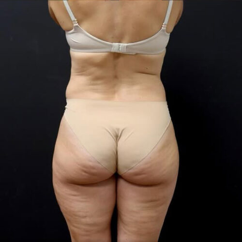 Liposuction Before and After Gallery