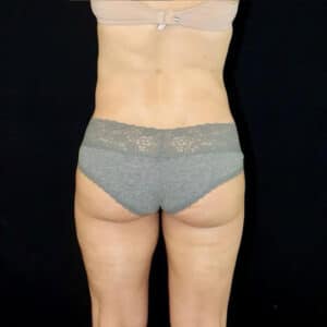 Liposuction Before and After Gallery