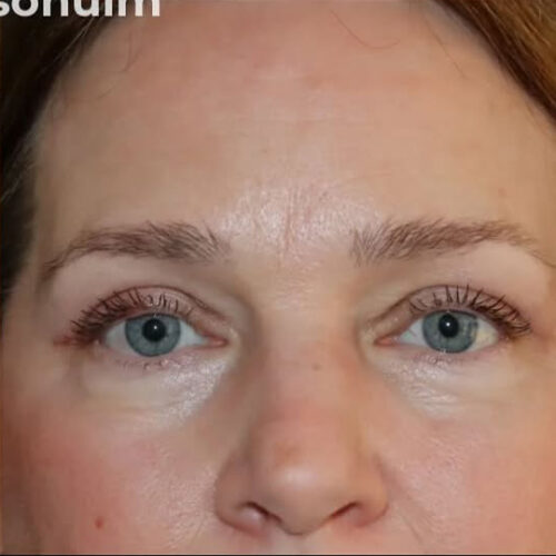 Eyelid Surgery Before and After Gallery