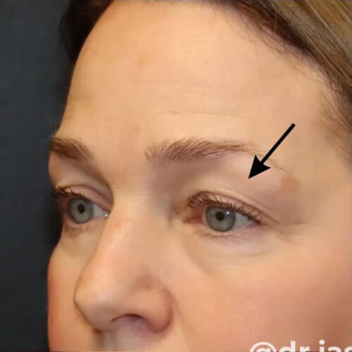 Eyelid Surgery Before and After Gallery