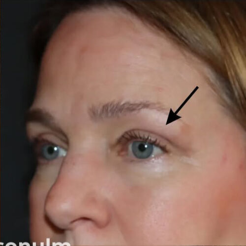 Eyelid Surgery Before and After Gallery