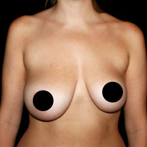 Breast Lift Before and After Gallery