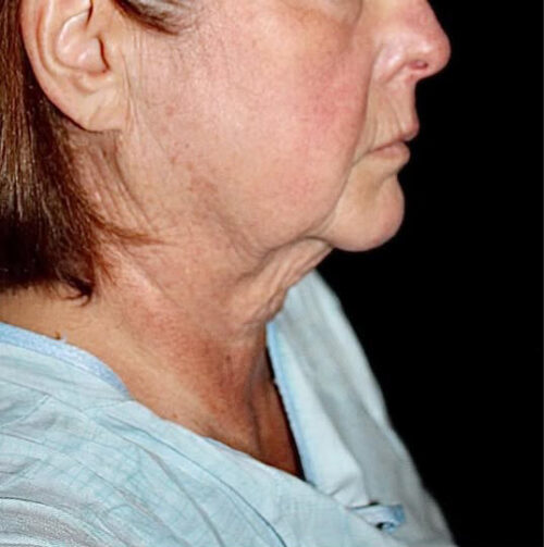 Face and Necklift Before and After Gallery