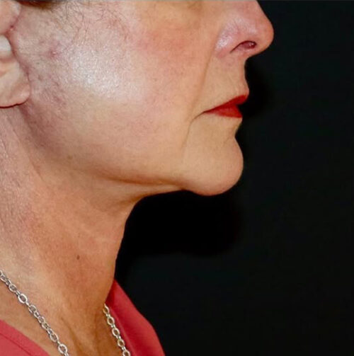 Face and Necklift Before and After Gallery