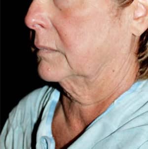 Face and Necklift Before and After Gallery