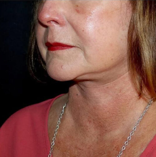 Face and Necklift Before and After Gallery