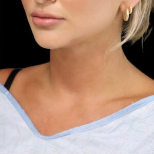 Submental Liposuction Before and After Gallery