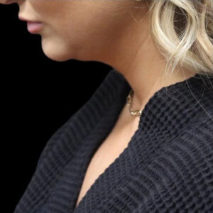 Submental Liposuction Before and After Gallery