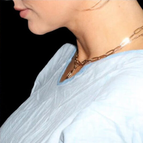 Submental Liposuction Before and After Gallery