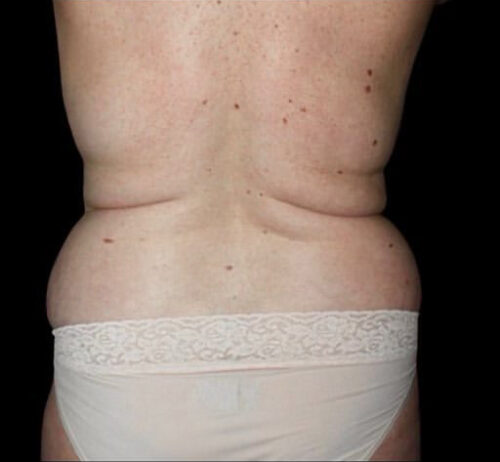 Liposuction Before and After Gallery