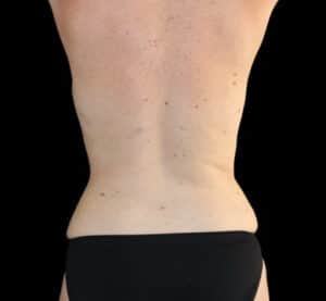 Liposuction Before and After Gallery