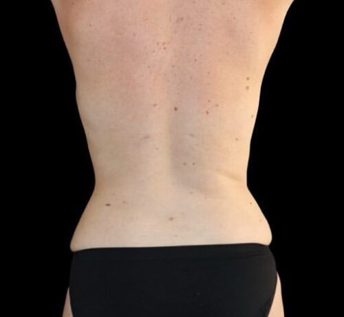 Liposuction Before and After Gallery