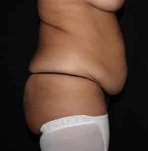 Tummy Tuck Before and After Gallery