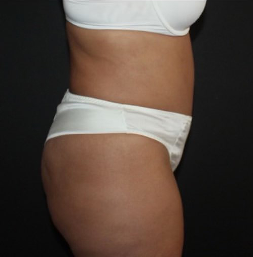 Tummy Tuck Before and After Gallery