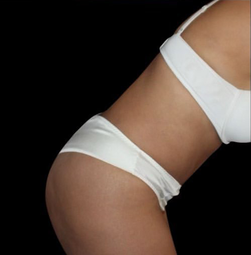 Tummy Tuck Before and After Gallery