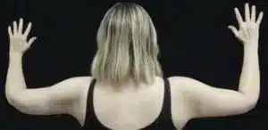 Arm Lift Before and After Gallery