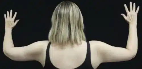 Arm Lift Before and After Gallery