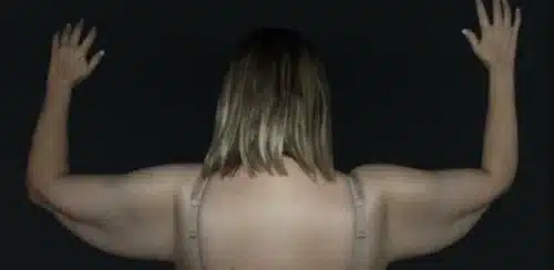 Arm Lift Before and After Gallery