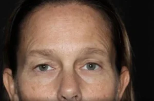 Eyelid Surgery Before and After Gallery