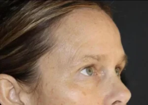 Eyelid Surgery Before and After Gallery