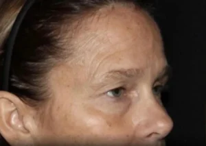 Eyelid Surgery Before and After Gallery