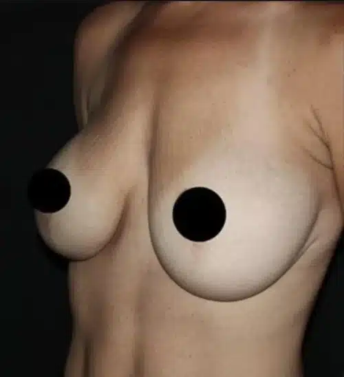 Breast Implant Exchange Before and After Gallery
