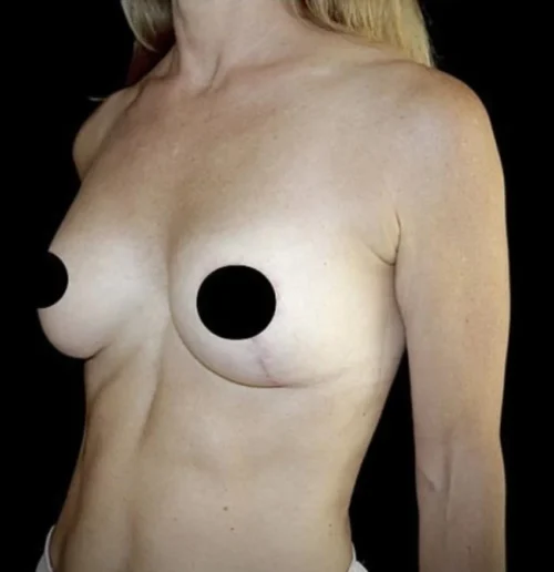 Breast Lift Before and After Gallery