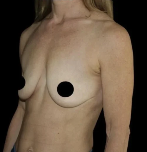 Breast Lift Before and After Gallery