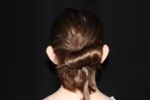 Ear Surgery Before and After Gallery