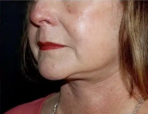 Face and Necklift Before and After Gallery