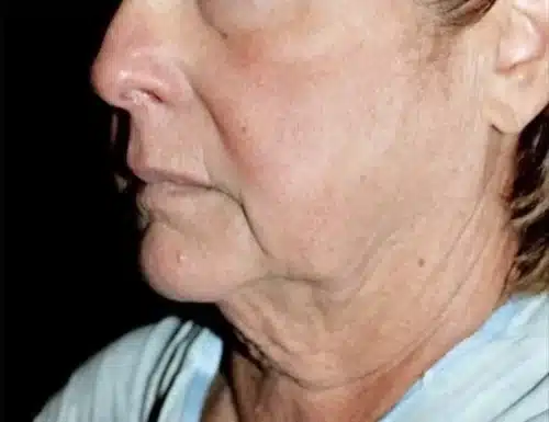Face and Necklift Before and After Gallery