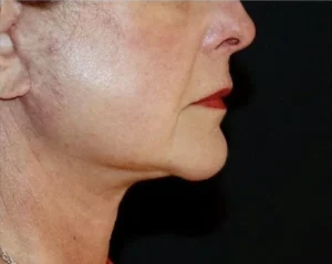 Face and Necklift Before and After Gallery