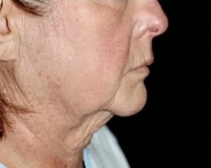 Face and Necklift Before and After Gallery