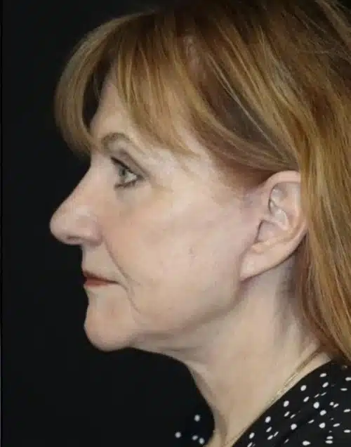 Face and Necklift Before and After Gallery